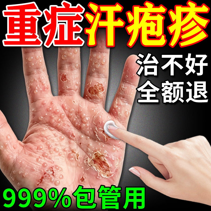 Specialized Ointment for Relieving Itching and Treating Sweat Blisters, Small Blisters on Hands, Peeling Skin, Fungal Infection, and Eczema Specialized Ointment for Relieving Itching and Treating Sweat Blisters, Small Blisters on Hands, Peeling Skin, Fungal Infection, and Eczema