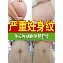DSM removes stretch marks fat lines caesarean section repair cream eliminates belly marks removes postpartum growth and tightens belly