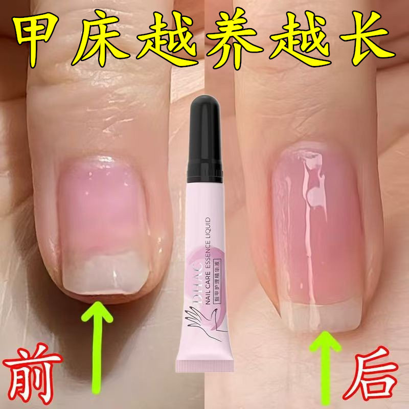 【Nail Growth Liquid】Nail Nourishing Oil to Prevent Nail Splitting, Peeling, and Cracking, Care for Vertical Lines, Prevent Breakage, and Protect Thin Nails