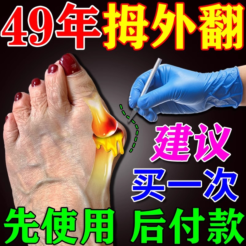 (Not Straight Total Odds) Large footed bones toe overlap thumb valgus Corrected God's toe deformity Swelling Pain Cream-Taobao