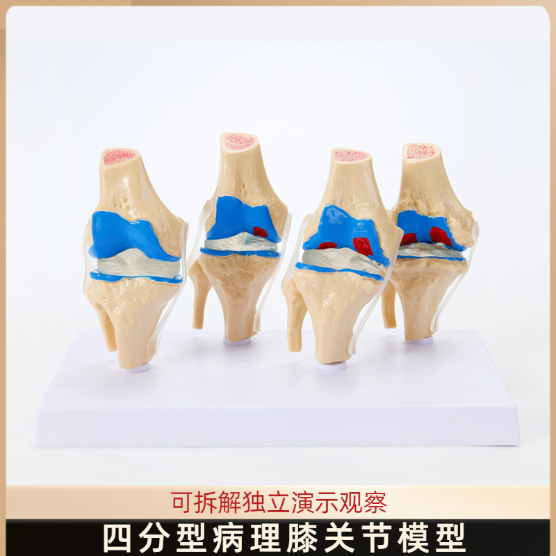病变膝关节模型 骨科教学展示膝盖 骨质曾生 病理膝关节骨骼模型