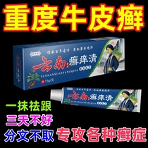 Treatment of stubborn psoriasis moss fresh psoriasis Body Eczema Eczema Eczema External Skin Disease Special Effective Medicine Cream