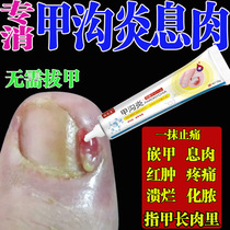 Paronychia polyp removal paronychia treatment special medicine paronychia softener ointment paronychia anti-inflammation and swelling