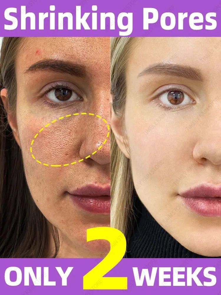 Minimizando o soro encolhendo do furo redu? ?o para o rosto-T