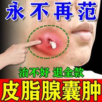 Sebaceous glandular acne pimple acne acne acne releving of subcutanee sузлах acne Acne Treating Sebaceous Glands Secretion of