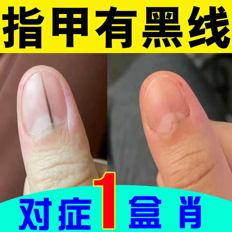 Remove Black Lines and Blood Stains on Nails, Treat Black Nails, Separate Yellow Thick Nails, Treat Uneven Nails, Separate Nail Flesh, Herbal Repair Remove Black Lines and Blood Stains on Nails, Treat Black Nails, Separate Yellow Thick Nails, Treat Uneven Nails, Separate Nail Flesh, Herbal Repair