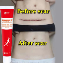 Acne Scar Removal Cream Pimples Stch Marks Surgical Remove G