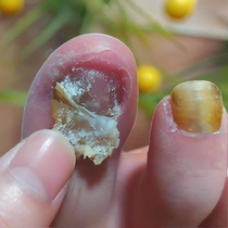 (Tongrentang hot sale) Replace potassium painlessly enjoy a good nail life and turn bad nails into good ones. Just put one drop in the morning and evening.