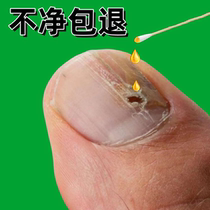 (Küchens hot selling) Drop a drop of bacteriostatic no-nail to remove 99% ash potassium fungus invalid packet withdrawal  