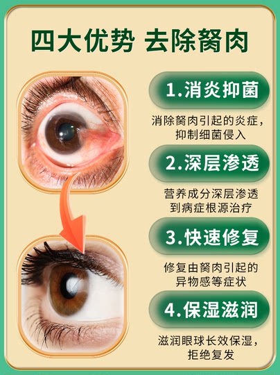Eye Drops to Remove Styes, Blurry Vision, and Foreign Body Sensation; Medicine for Treating Wing-Shaped Styes in the Corners of the Eyes