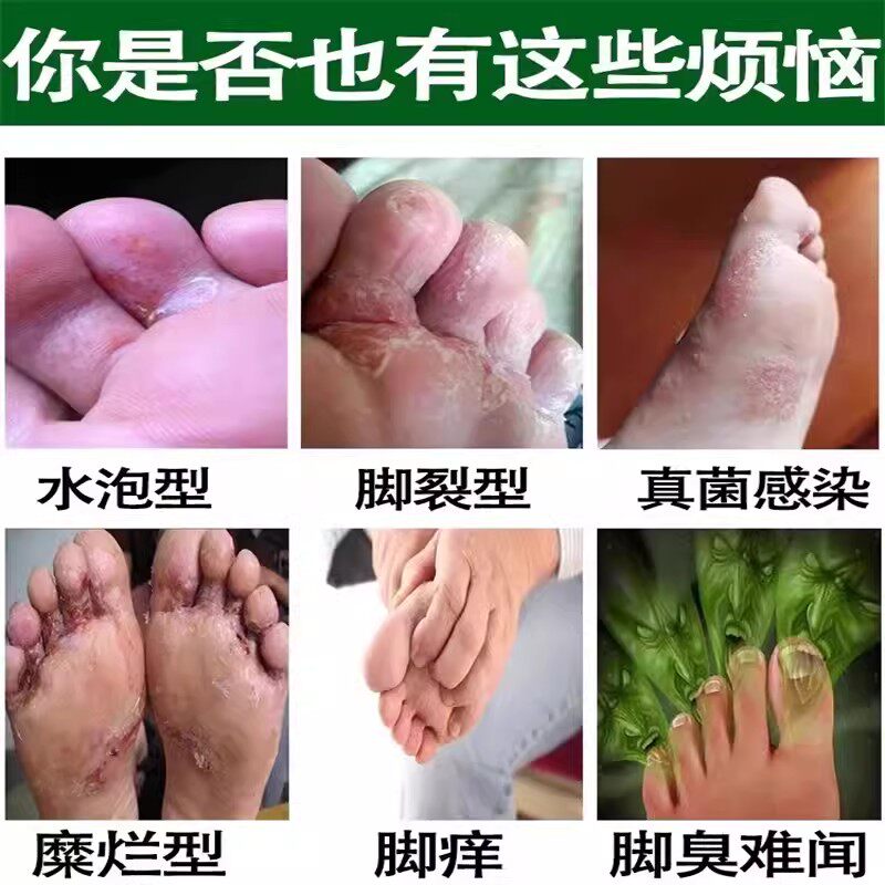 告别脚气困扰,专治脚痒脚癣的神奇喷雾!👣 -会计-淘宝百科网