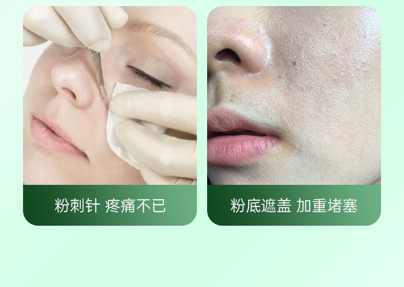 Сосать черный глава инструмент 康佳可视吸黑头仪去黑头铲粉刺电动强力吸出器清洁神器导出美容仪 Konka