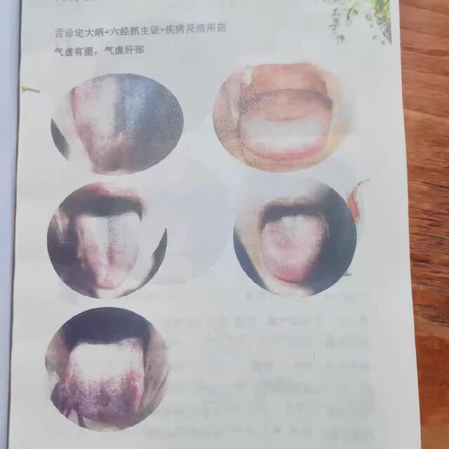 Yang Chunhu[Practical Insights into Traditional Chinese Medicine]Color Print Edition: Tongue Diagnosis and Prescription Analysis, Diagnosis of Febrile Diseases, How Traditional Chinese Medicine Diagnoses Diseases