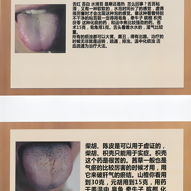 Yang Chunhu’s Tongue Diagnosis Formulas and Basic Knowledge of Tongue Diagnosis and Disease Recognition: Start with Dialectics of Tongue Quality for Typhoid Fever, Color Print
