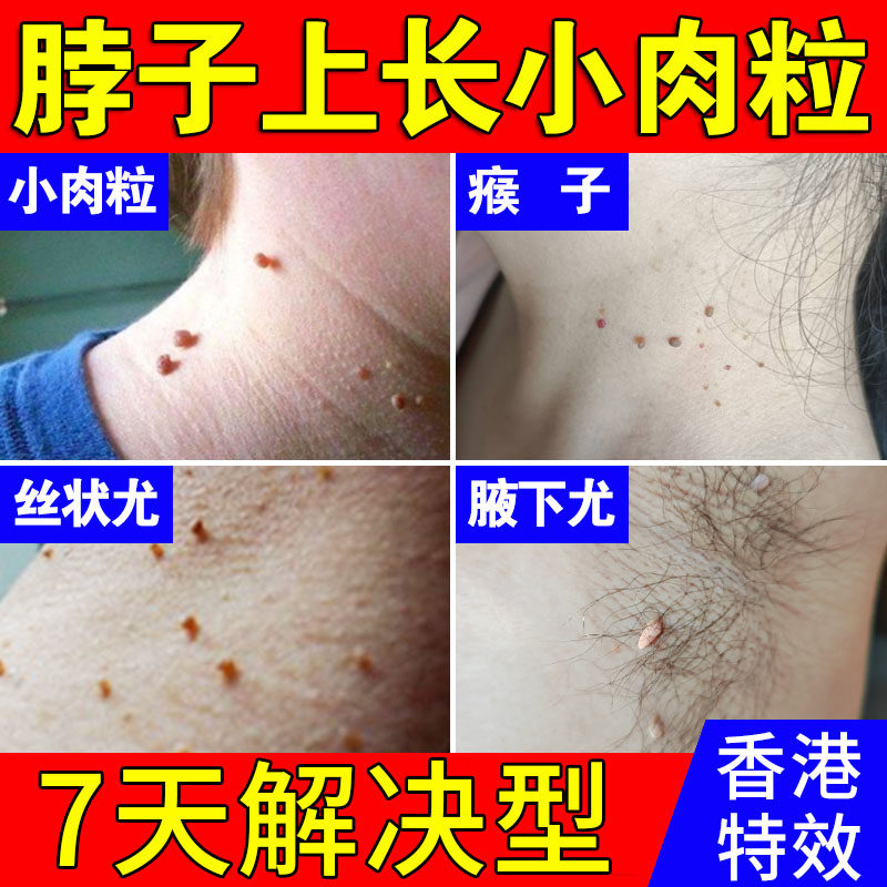 扁平疣瘊子去除膏：告别颈部脖子小肉粒，腋下丝状疣肉球不再烦恼！-洁面皂-淘宝好物网