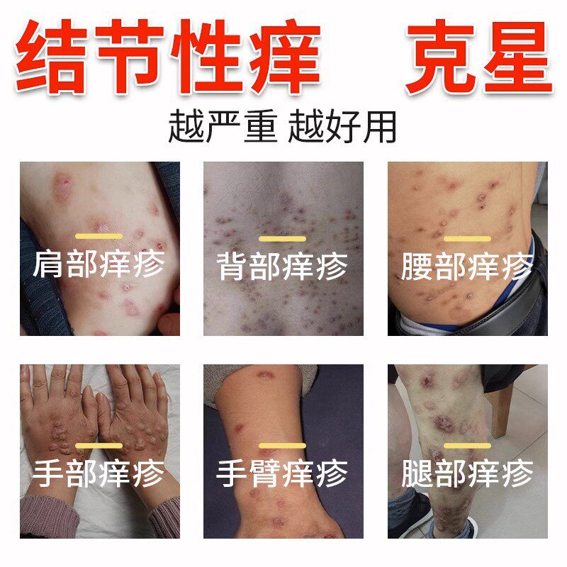 25年必买！痒疹结节性皮炎克星｜红肿瘙痒根治药膏测评-小宠医疗用品-淘宝好物网