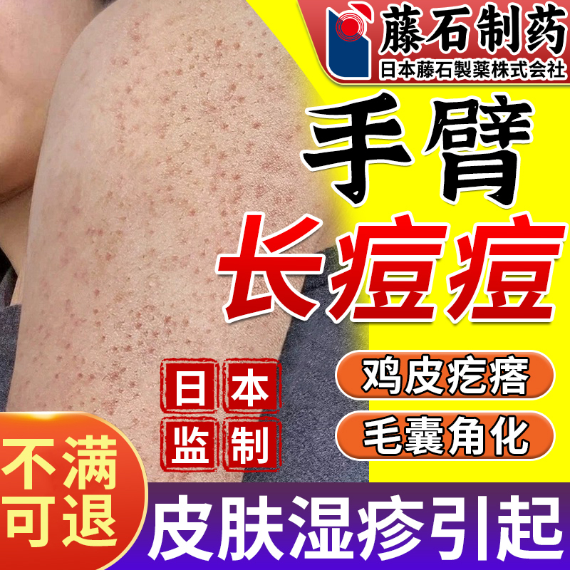 Special Spray for Arm Folliculitis, Small Bumps and Red Spots on the Arm, Keratosis Medication, Fda Registered Om