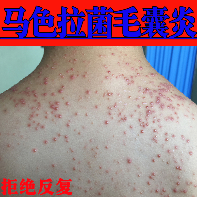 Treatment. Folliculitis Ointment for Scalp, Chest, Back, Arms, Acne Pimples, Hair Follicle Blockage, Exfoliation, Seborrhea Treatment. Folliculitis Ointment for Scalp, Chest, Back, Arms, Acne Pimples, Hair Follicle Blockage, Exfoliation, Seborrhea