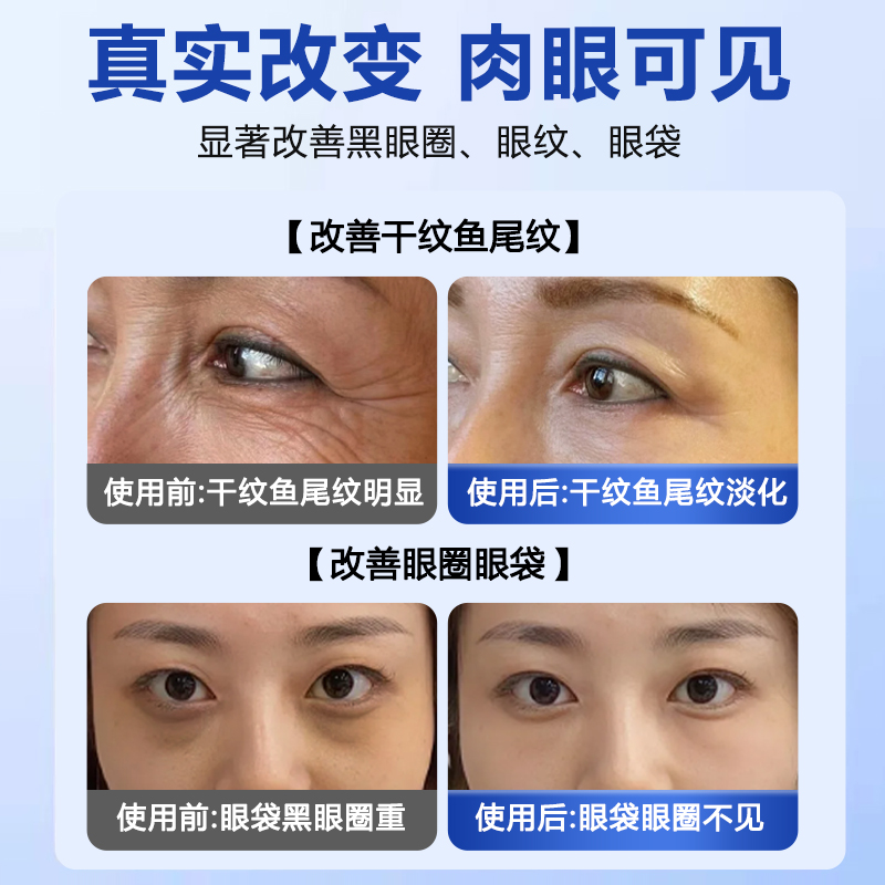 眼袋手术真的能彻底解决眼袋问题吗？