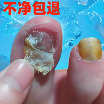 (Watson’s hot sale) One drop will inhibit bacteria without removing nails remove 99% of gray potassium fungi and return the money if it is not clean.