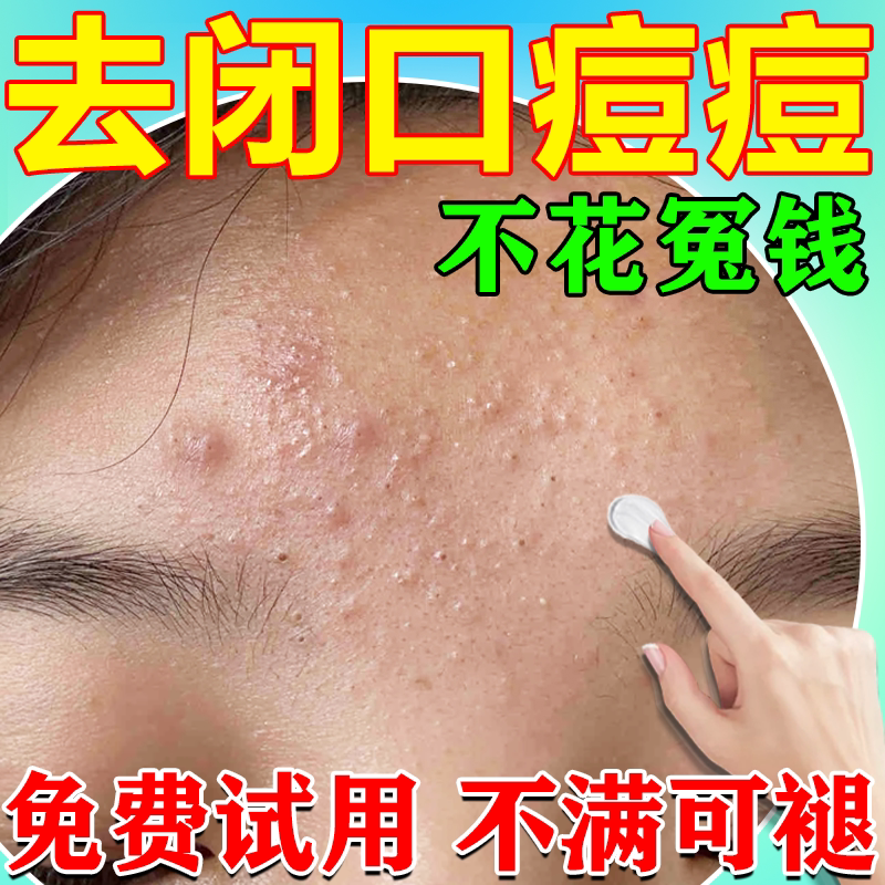 Remove Acne and Closed Comedones! Anti-Acne Cream for Repairing Small Pimples on the Face and Eliminating Facial and Chin Acne