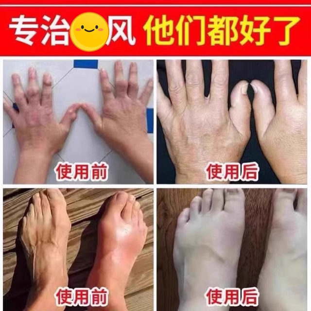 Recombinant Uric Acid Oxidase Inhibitor Tablets, Acidase Enzyme, Magnesium Enzyme, Xanthine, Pain Relief, Nutritious Flaxseed Tablets, Genuine Product