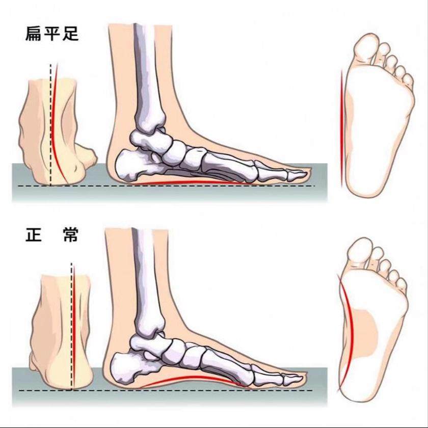 Special Shoes for Flat Feet, Women's Shoes for Autumn and Winter, Corrective for Splayed Feet, Valgus Foot, Arch Support, Fleece-Lined, Warm Sports Shoes