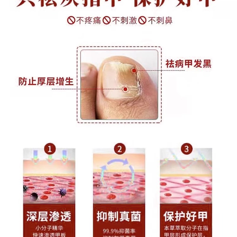 【不净包退】快速去除坏甲，灰指甲克星，急脾气也能等来完美脚趾！