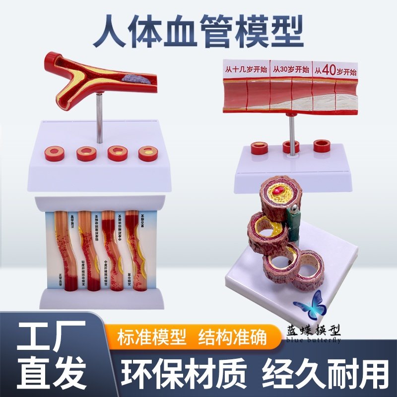 Human Cardiovascular Hierarchical Structure Anatomy Blockage Model Thrombosis Fat Pathology Arteriovenous Enlargement and Hardening Teaching Aids
