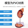 Human Kidney Model, Kidney Anatomy with Adrenal Gland Enlarged Model, Diseased Kidney, Human Internal Organ Anatomy