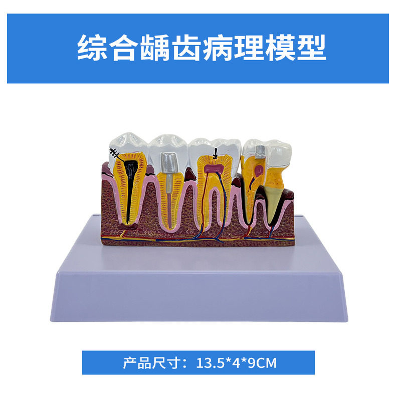 牙科口腔诊所龋齿蛀牙病理牙解剖模型牙齿模型刷牙教学模型幼儿园