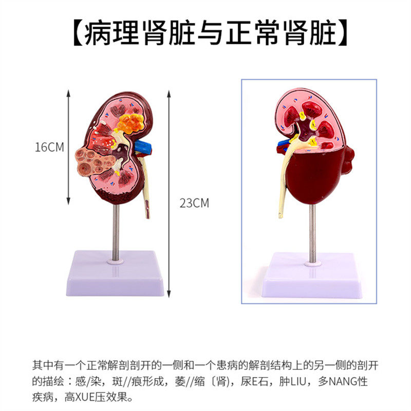 Human Kidney Model, Kidney Anatomy with Adrenal Gland Enlarged Model, Diseased Kidney, Human Internal Organ Anatomy