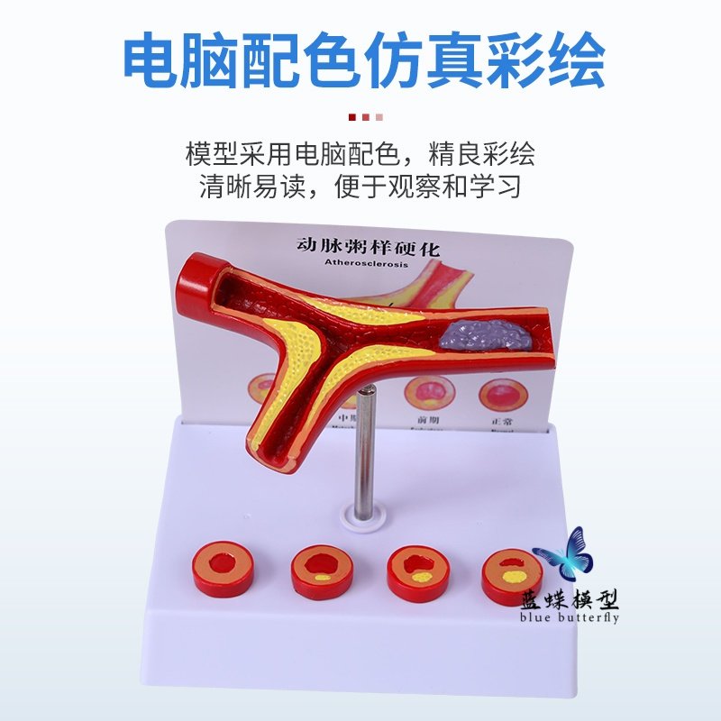 Human Cardiovascular Hierarchical Structure Anatomy Blockage Model Thrombosis Fat Pathology Arteriovenous Enlargement and Hardening Teaching Aids