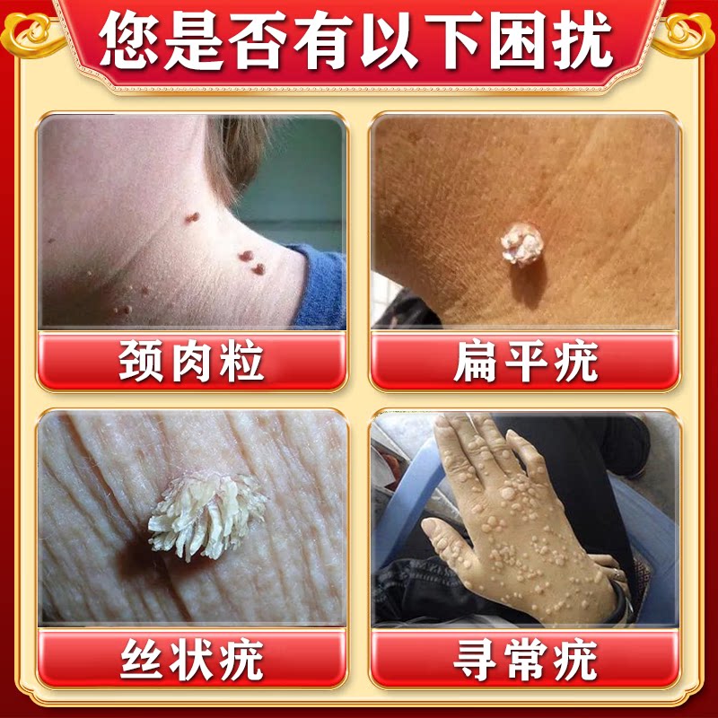 马应龙水杨酸软膏：丝状疣小肉粒克星，脖子上的烦恼终结者！-癣症-淘宝百科网