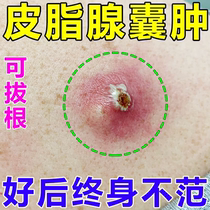 Remove sebaceous cysts nodular acne lumps powdery tumors pustules remove subcutaneous cysts fire boils and remove pus with ointment