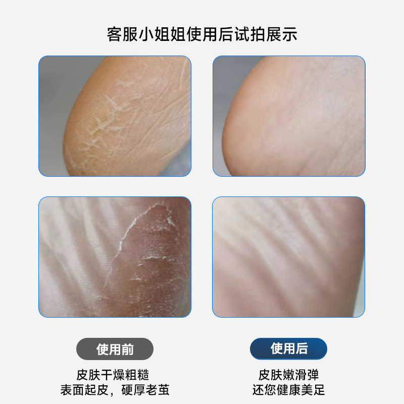 Electric Foot File for Removing Dead Skin and Calluses