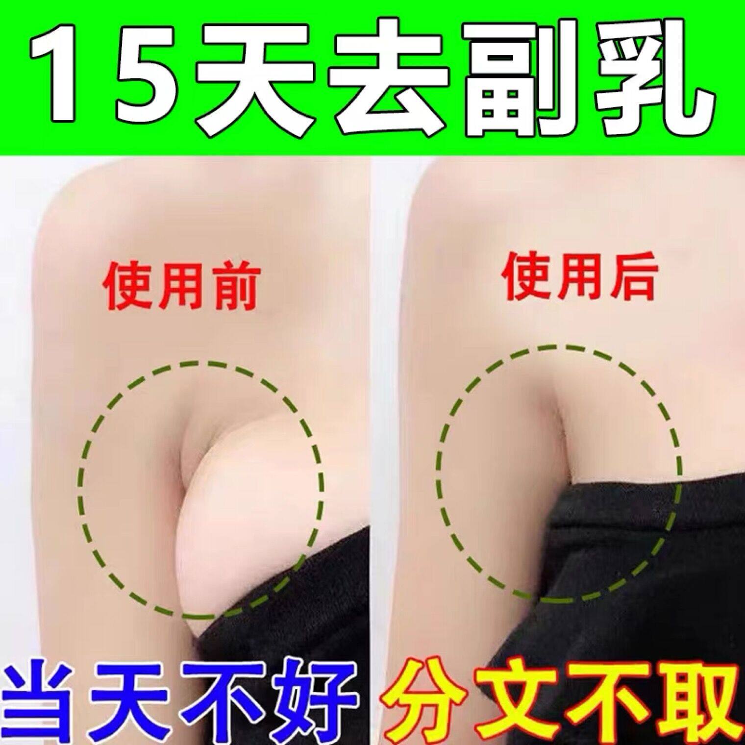 Auxiliary milk elimination paste to remove the auxiliary milk artifact (specialized) lymph node Zhongda dredging detoxification armpit special plaster
