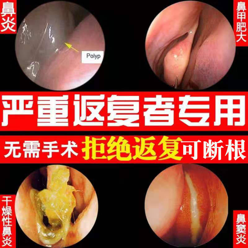 Cocklebur rhinitis special effect turbinate fertilizer specialist medicine radical rhinitis ointment pure middle Miaojia children's spray medicine