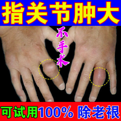 Finger joint deformation, swelling, thick gout, new version of special medicine, crystallization, stiffness and uric acid special stickers