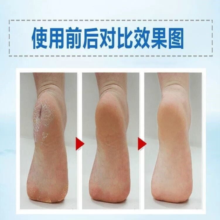 Read Kirin Skin Care Cream Inexhaustible American Leate Furoguan Official Web Peeling Suit Hands And Feet Dry Crack Cream Repair Cream