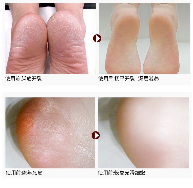 Muối ngâm chân ngâm chân ngứa để đi đến muối tẩy trắng chân cũ để tẩy tế bào chết để loại bỏ muối ngâm chân để ngăn ngừa nứt chân chăm sóc chân kem dưỡng trắng da tay chân
