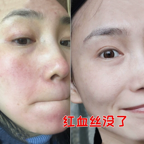 [Рекомендуется Xiaohongshu] Fack Red Dots на лице, красный шелк, прощание с чувствительным к красному плато и стреляйте 2 раунда 3 ~