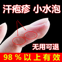 Lis special ointment sweat herpes oil ointment hands small blisters hand peeling root finger sweat spore treatment