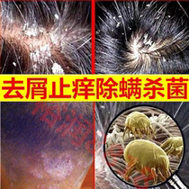 Anti-dandruff artifact head oil anti-itch anti-itch anti-itch anti-itch anti-itch anti-itch anti-itch anti-itch anti-itch anti-itch anti-itch anti-itch
