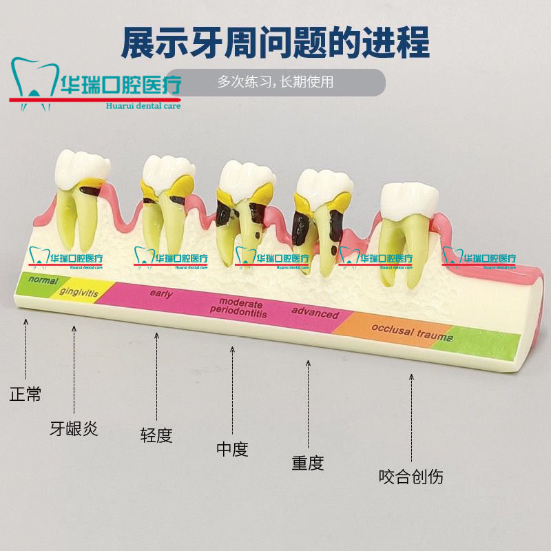 牙齿口腔展示模型牙周并变重的过程牙科医患沟通展示模型