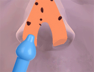洗鼻器B型_03_02.gif