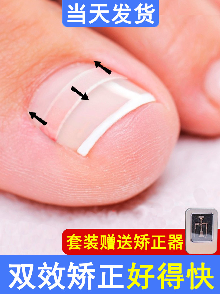 Nail patch Nail groove embedded nail corrector Toenail patch corrects toenail pull patch Orthosis corrects non-inflammatory