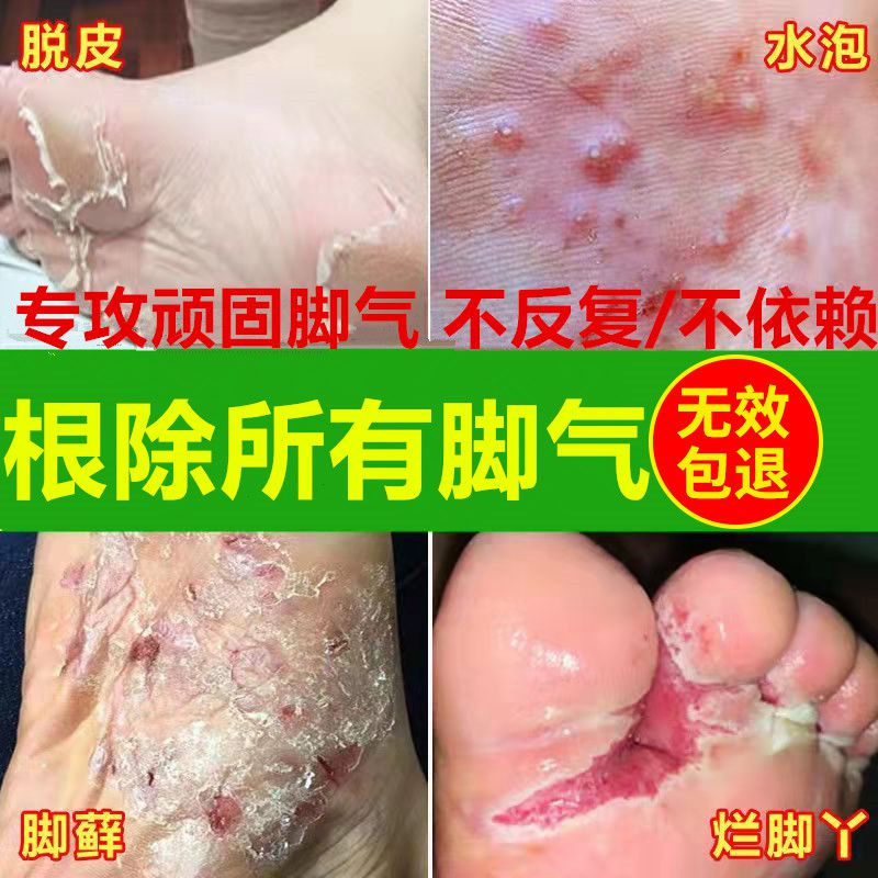 Treat your feet to root the root deity Medicated Antipruritic Fungus Peeling and Blistering Feet of the Foot Piste and Rotten Feet
