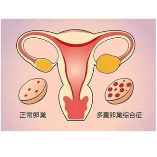 2 Polycystic ovary syndrome DCI handosteroids improve Chinese medicine tea menstrual pour feet to promote ovulation and pregnancy