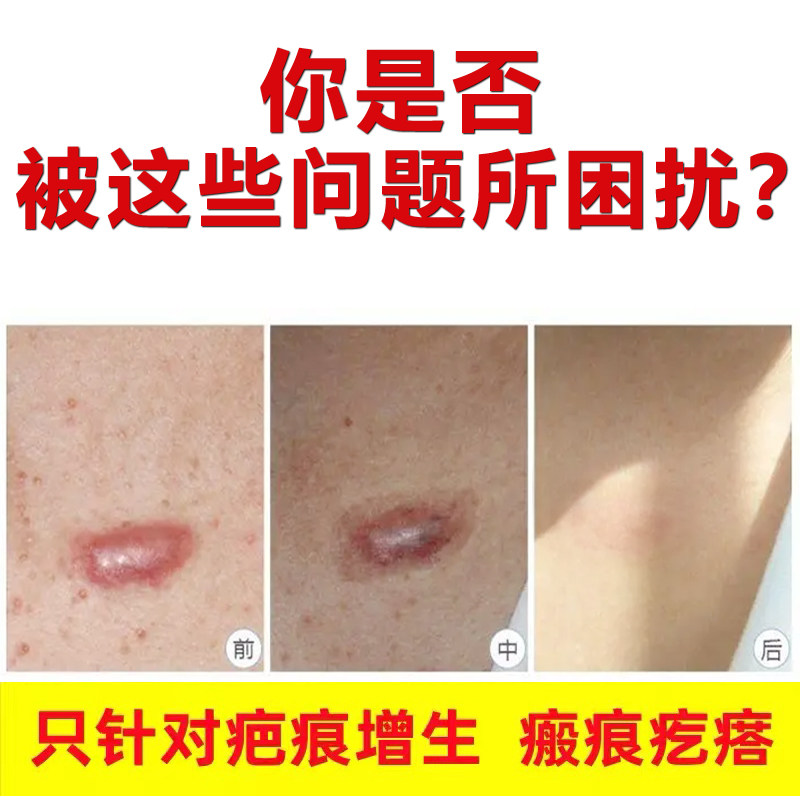 胸前疤痕疙瘩增生凸起？试试这些去除修复妙招，告别疤痕烦恼！-淡疤护理-淘宝百科网